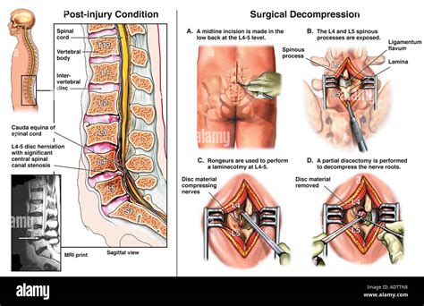 Lumbar Disc Herniation L With Surgical Laminectomy And Discectomy Stock Photo Royalty Free