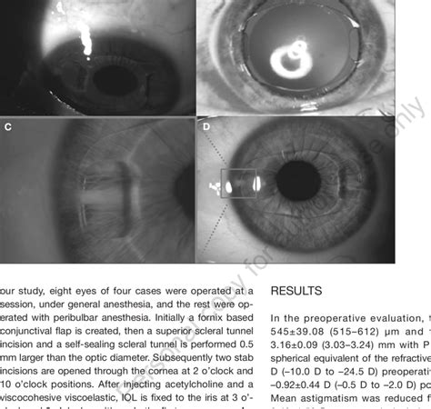 A Scleral Tunnel B Dilated Pupil C D Enclavation Sites Of Our