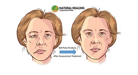 Acupuncture Heals Bell Palsy Facial Paralysis