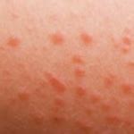 They arent raised at all and dont hurt or itch. Red spots on skin, but not itchy? Find out the common ...