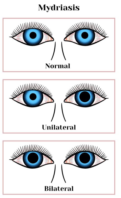 Pupils Dilated Different Sizes