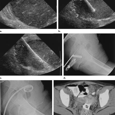Percutaneous Drainage Of Subdiaphragmatic Abscess Cpt Code Best Drain