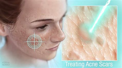 Mayo Clinic Q And A Treatment Options For Acne Scars That Dont