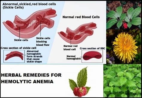 Herbal Remedies For Hemolytic Anemia Natural Fitness Tips