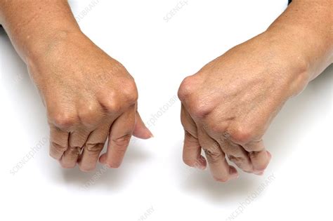 Rheumatoid Arthritis Of The Fingers Stock Image C0142478 Science
