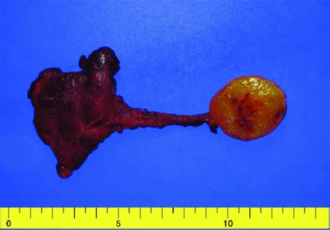 The Surgical Specimen After Lobectomy Of The Left Thyroid Gland