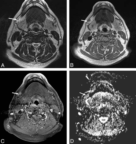 Prediction Of Nodal Metastasis In Head And Neck Cancer Using A 3t Mri