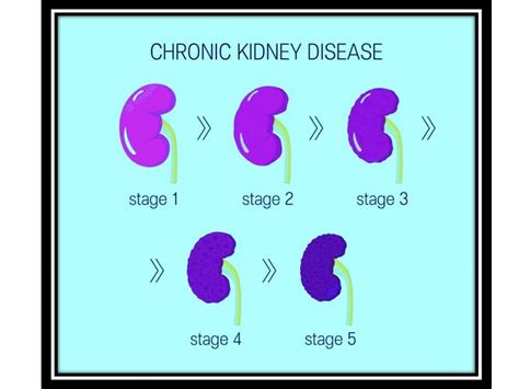 5 Stages Of Kidney Disease Dr Kavitha Gone Explains