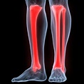 Tibial Fracture after Accident – The Vrana Law Firm Personal Injury ...