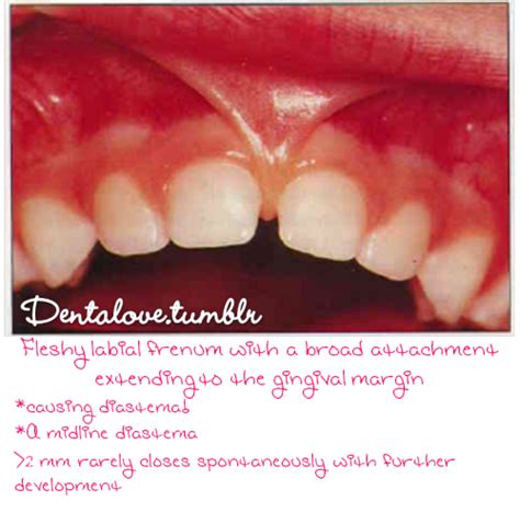 Wenny S Dental World The Labial Frenulum Often Attaches To The Center