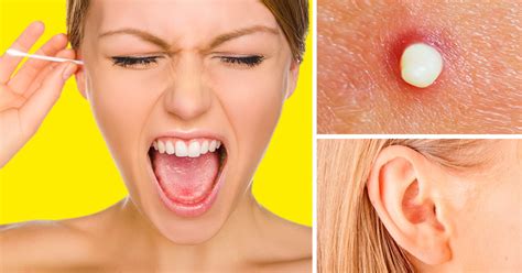 10 Ways To Get Rid Of Annoying Pimples In Your Ear It Only Takes A