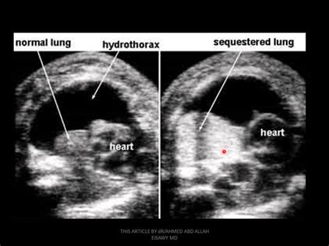 24 Fetal Chest Ultrasound B Dr Ahmed Esawy Youtube