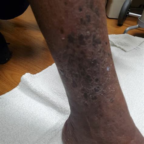 Purple Patchy Kaposi Lesions Extensively Involving The Right Leg