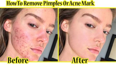 How To Quickly Remove Pimple Marks And Remove Acne In Photoshopscars