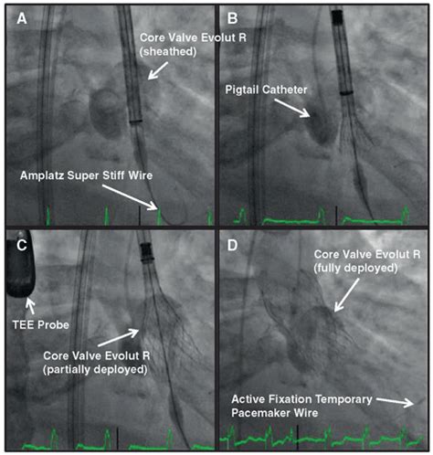 Transcatheter Aortic Valve Replacement Thoracic Key