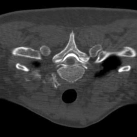 Ct Myelography Shows Extravasation Of Contrast Into The Epidural Space