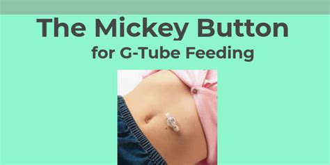 The Mickey Button For G Tube Feeding Infogram