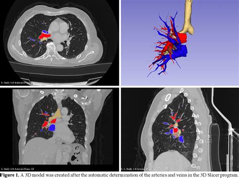 Figure 1 From Effect Of Preoperative Three Dimensional Modeling On