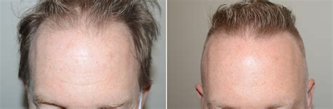 Hair Transplants For Men Photos Miami FL Patient125258