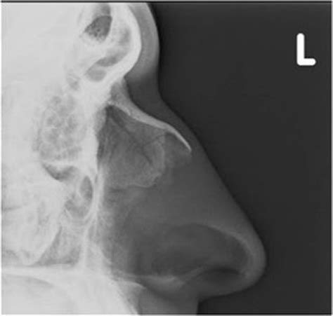 August 31, 2020 reading time: Nasal Bone Fracture- Grey Zone - Sumer's Radiology Blog