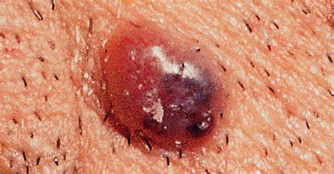 Cancer Black Spot On Skin