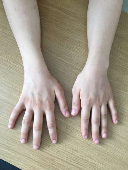 Dorsal View Of Both Hands Pronounced Thenar Atrophy Of The Right Hand
