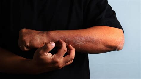 Eczema On Scalp African American
