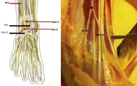Branching Patterns Of The Superficial Peroneal Nerve Implications For