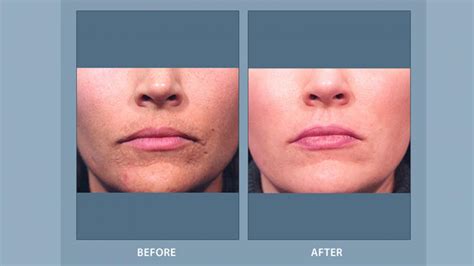 Laser Resurfacing Before And After Results Facial Cosmetic Surgery