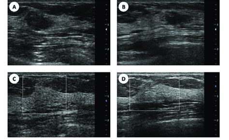 A 26 Year Old Female With Fibroadenoma On Ultrasound Image A A
