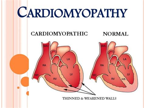 Ppt Heart Muscle Disease Cardiomyopathy Powerpoint Presentation