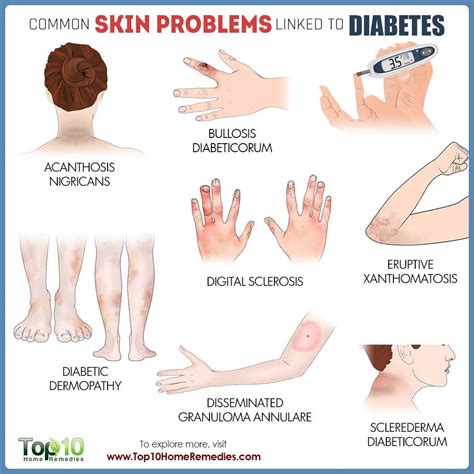 Common Skin Problems Linked To Diabetes Top 10 Home Remedies