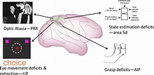 Optic Ataxia: From Balint’s Syndrome to the Parietal Reach Region: Neuron
