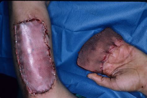 Trauma: Multiple finger degloving treated with medial cross arm flap ...