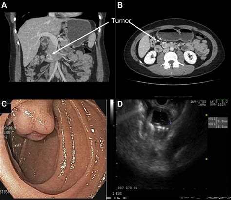 Local Resection For Duodenal Gastrointestinal Stromal Tumors The American Journal Of Surgery