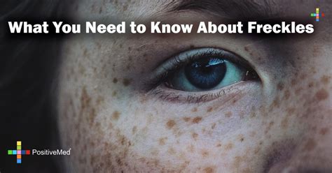 What You Need To Know About Freckles Positivemed