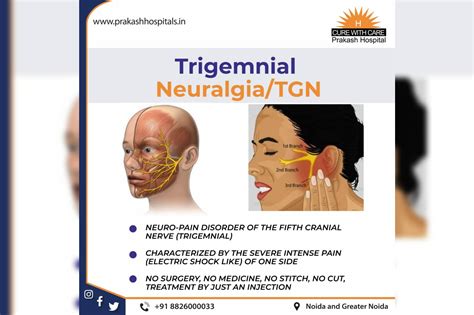 Jaw Pain Trigeminal Nerve