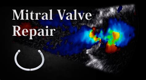Mitral Valve Repair Surgery What You Need To Know • Myheart