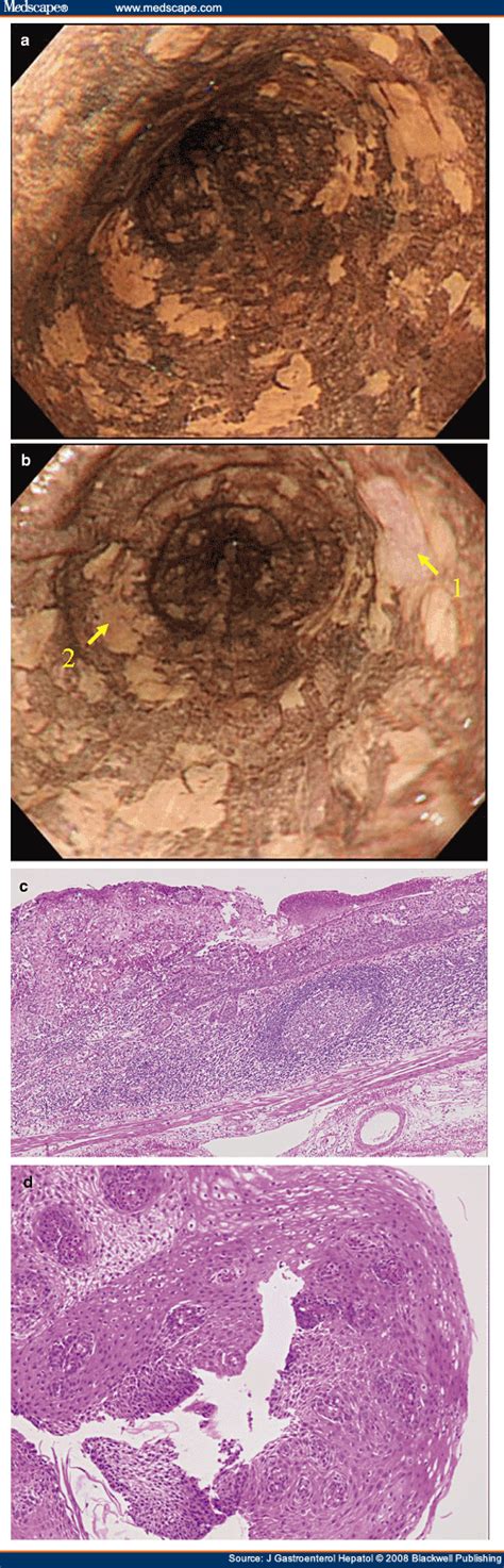 Diagnosis Of Squamous Neoplasia Of The Esophagus With Iodine Staining