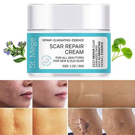 Best Fast Scar Removal Creams Of Everything Pantry