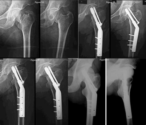 Osteosynthesis Of Fracture Neck Femur In The Sixth And Seventh Decades