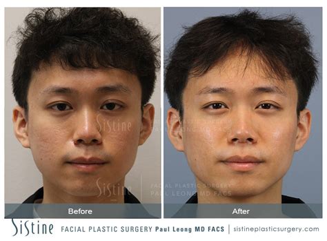 Skinpen Microneedling Before And After Sistine Facial Plastic Surgery