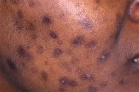 Black Spots On Skin Dots Patches Dark Tiny Itchy Pictures Causes