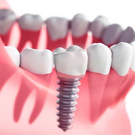 ¿qué Nos Aportan Los Implantes Dentales Esprohident