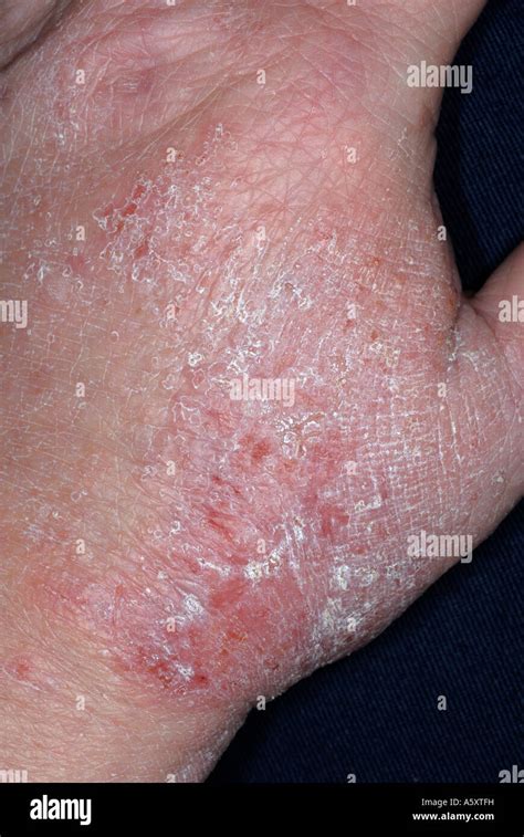 Skin Rash Of Eczema On The Hands Of A 52 Year Old Female Stock Photo