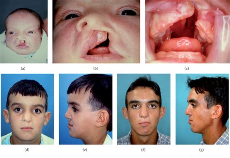 Cleft Lip And Palate Adult