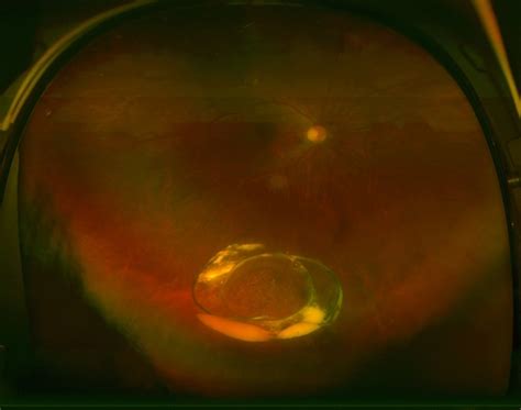 Dropped Iol Into The Vitreous Cavity Retina Image Bank