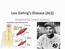 PPT - Lou Gehrig’s Disease (ALS) PowerPoint Presentation, free download ...