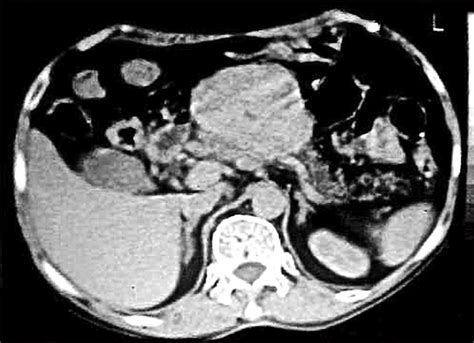 Scielo Brasil Glucagonoma Syndrome Associated With Necrolytic