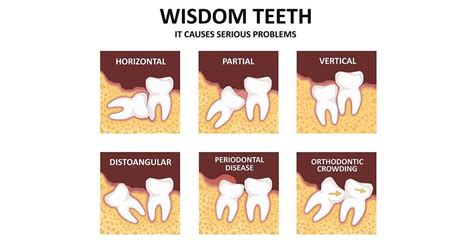 Wisdom Teeth Natural Dental Clinic Shore Dental Centre